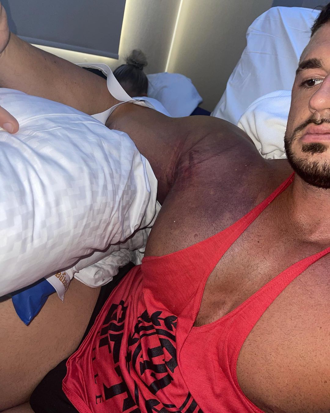 Ryan-Crowley, culturistul căruia i-a explodat mușchiul