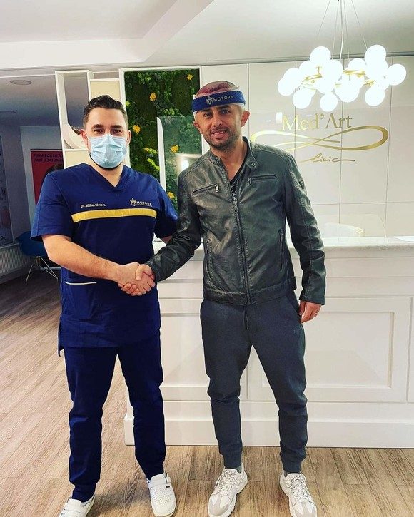 Nicolae Dică și-a făcut implant de păr